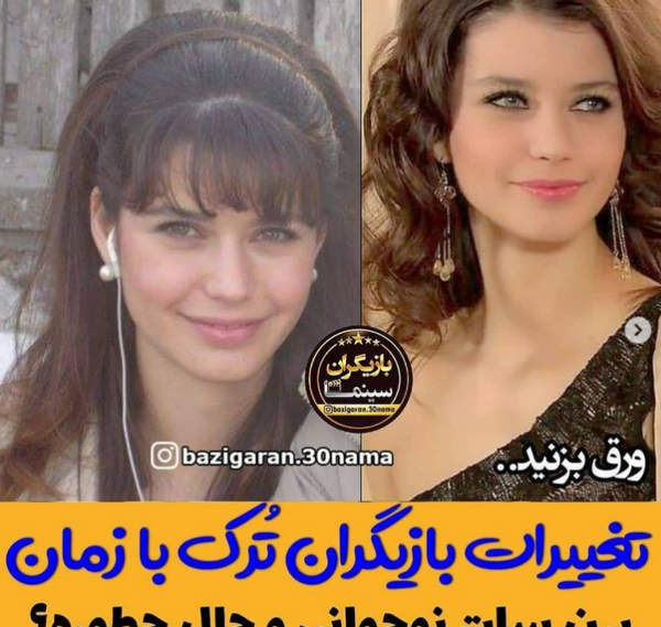عکس قبل از عمل برن سات