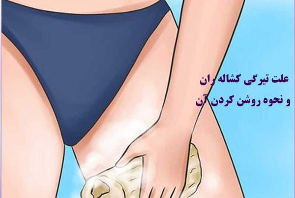 عکس کبودی کشاله ران پا