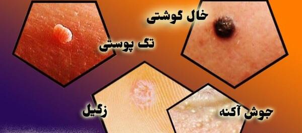 عکس جوش ناحیه تناسلی