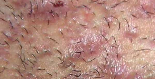 عکس جوش ناحیه تناسلی