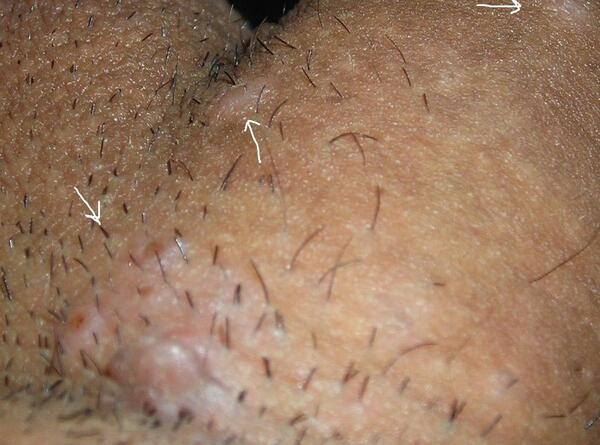 عکس جوش ناحیه تناسلی