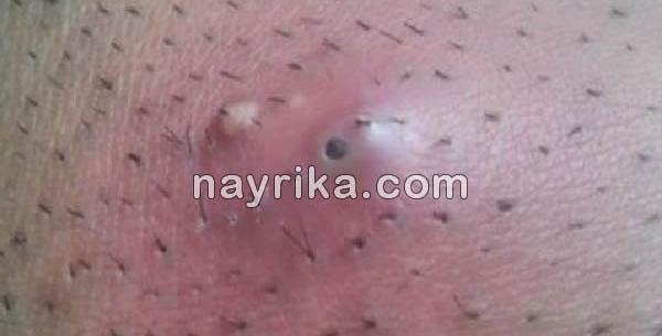 عکس جوش ناحیه تناسلی