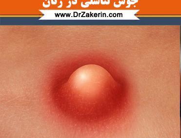 عکس جوش ناحیه تناسلی