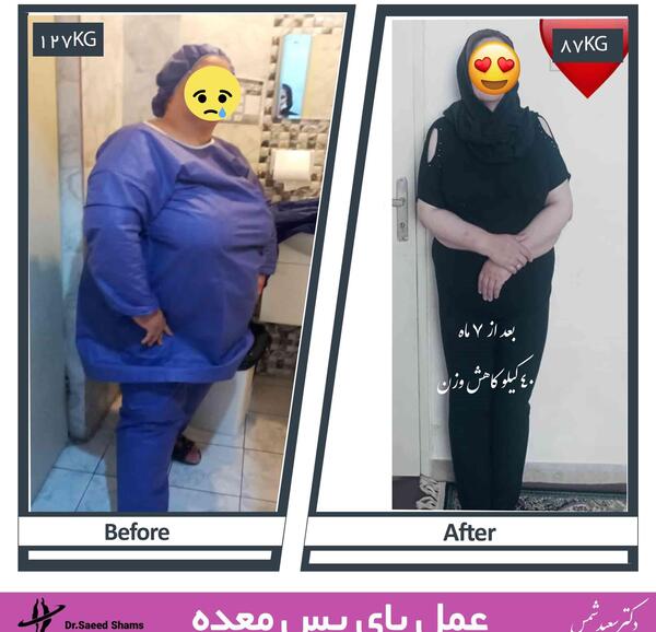 عکس لاغری قبل و بعد