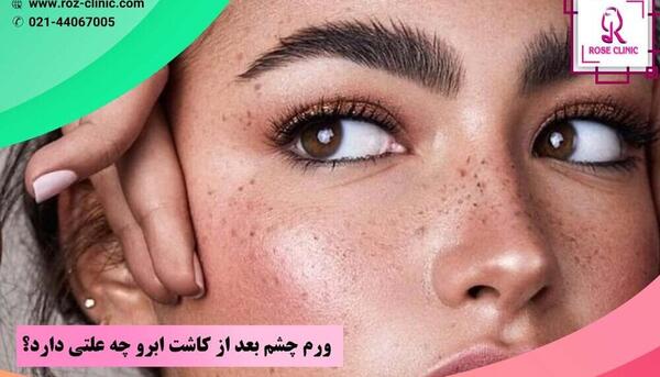 عکس کبودی پیشانی