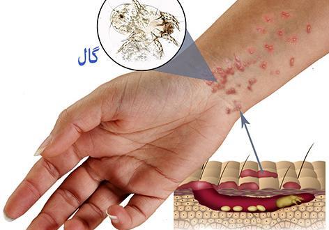 عکس از بیماری گال