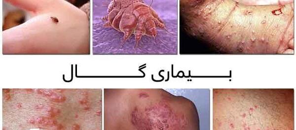 عکس از بیماری گال