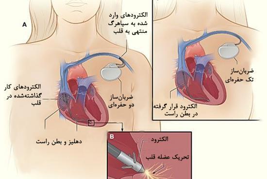عکس دستگاه ضربان ساز قلب