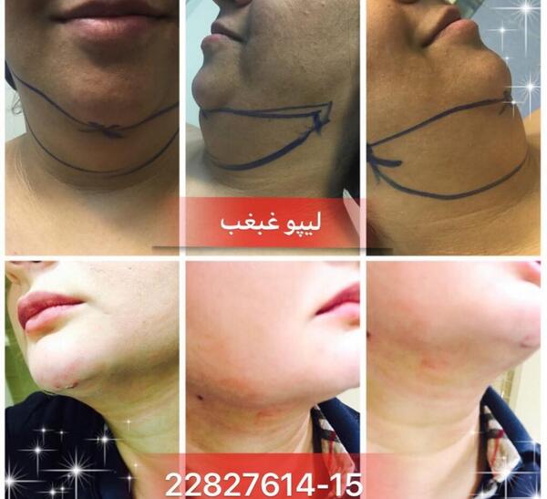 عکس غبغب قبل از عمل