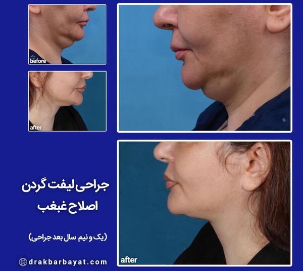 عکس غبغب قبل از عمل