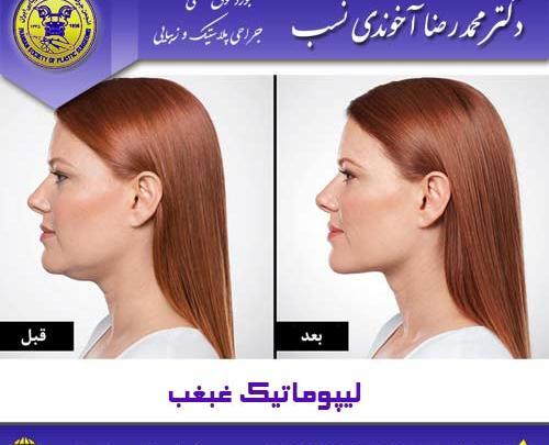 عکس غبغب قبل از عمل