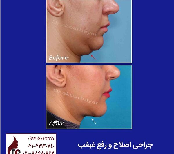 عکس غبغب قبل از عمل