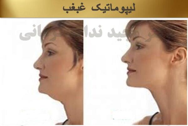 عکس غبغب قبل از عمل