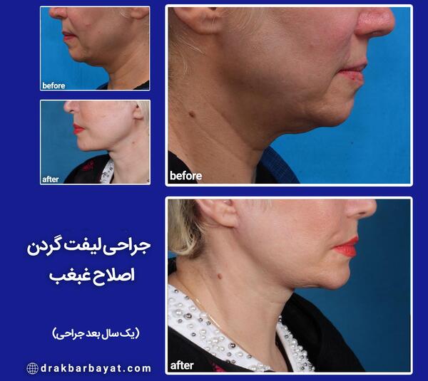 عکس غبغب قبل از عمل