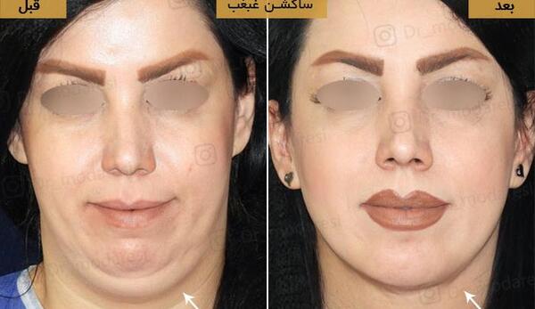 عکس غبغب قبل از عمل