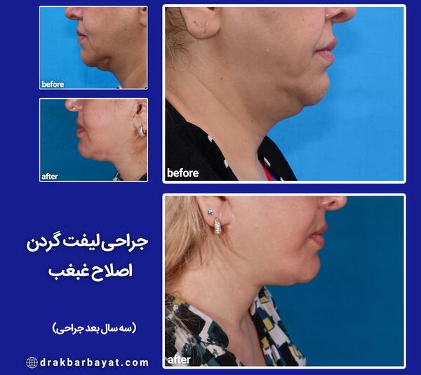 عکس غبغب قبل از عمل