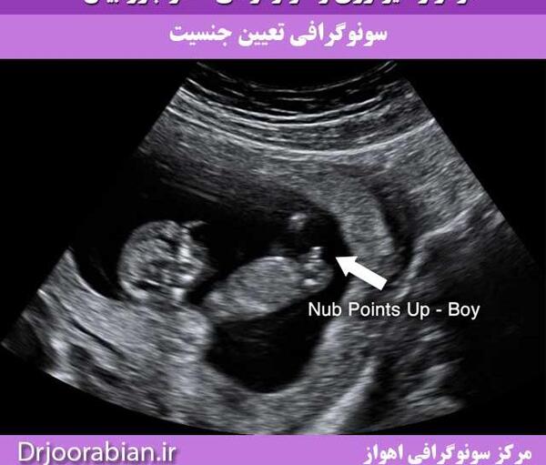عکس جنین پسر در غربالگری اول