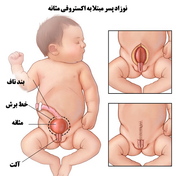 عکس فتق نوزاد پسر