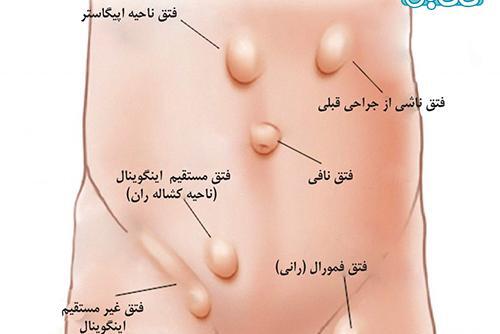 عکس فتق نوزاد پسر
