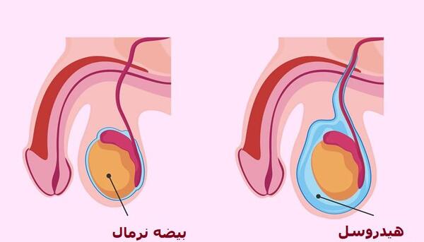 عکس فتق نوزاد پسر