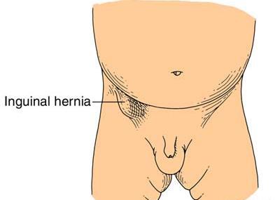 عکس فتق نوزاد پسر