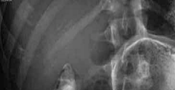 عکس ساده شکم چیست