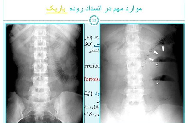 عکس ساده شکم چیست
