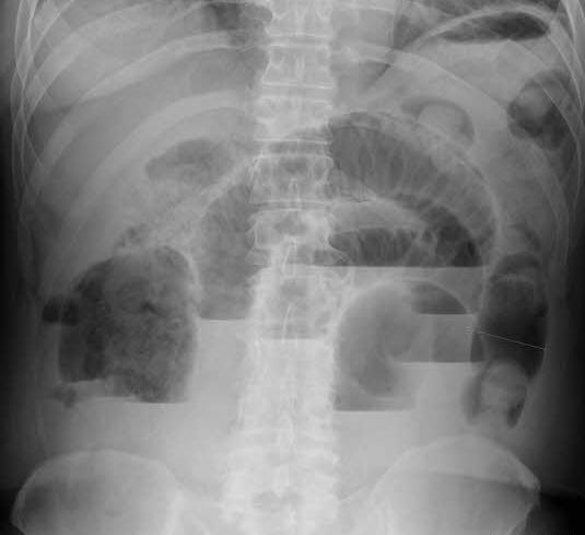 عکس ساده شکم چیست