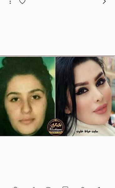 عکس قبل عمل دنیا جهانبخت