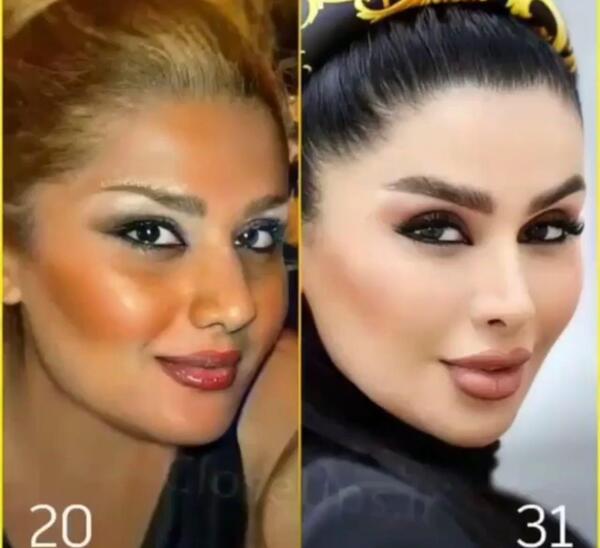 عکس قبل عمل دنیا جهانبخت