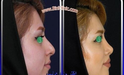 عکس تتلو قبل از عمل بینی