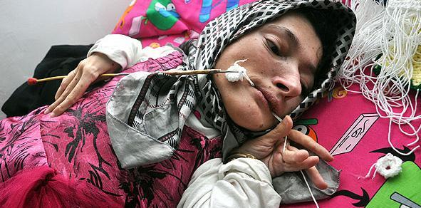عکس بچه های معلول ذهنی
