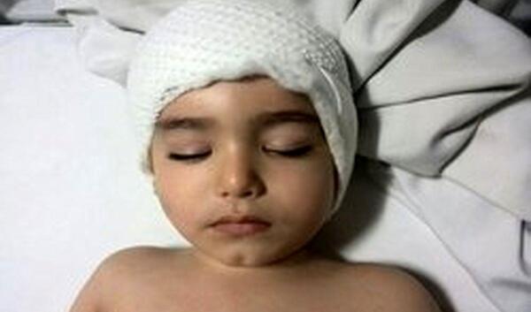 عکس بچه ضربه مغزی