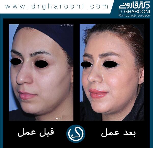 عکس چشم قبل عمل