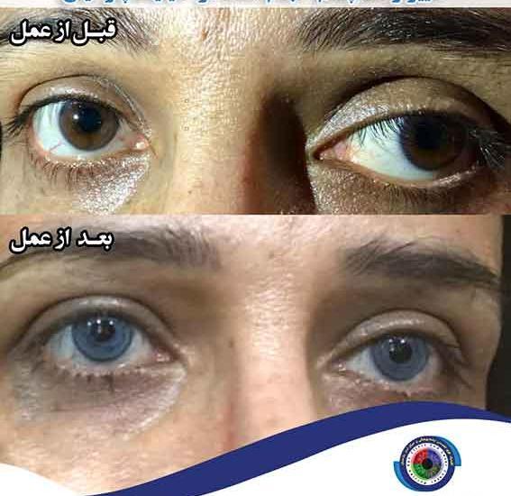عکس چشم قبل عمل
