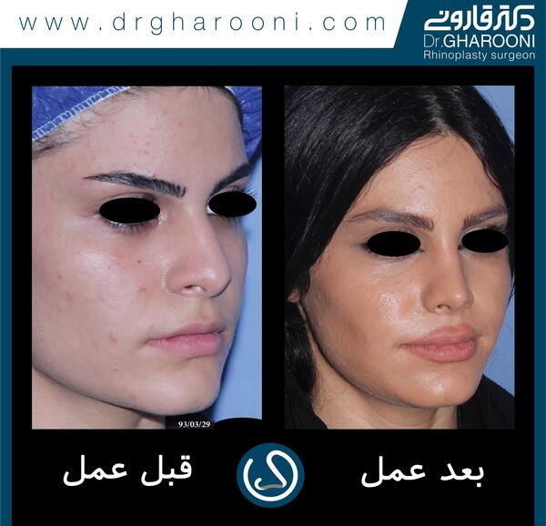 عکس چشم قبل عمل