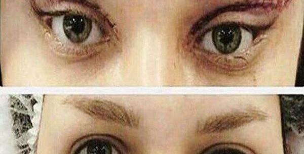 عکس چشم قبل عمل