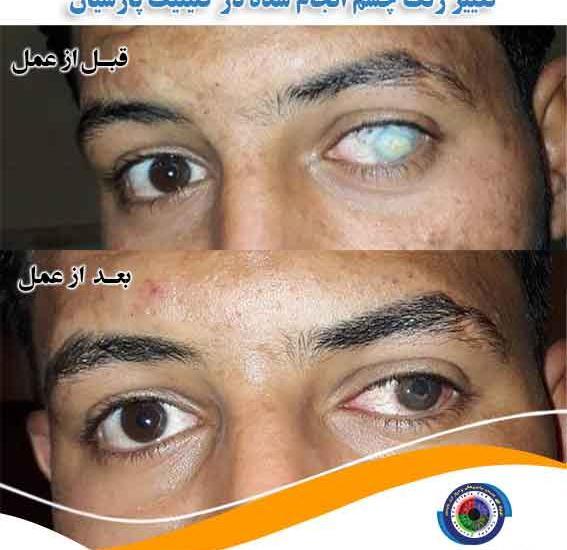 عکس چشم قبل عمل