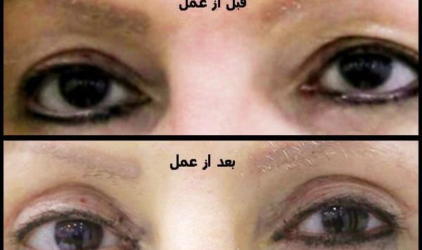 عکس چشم قبل عمل