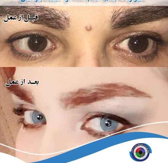 عکس چشم قبل عمل