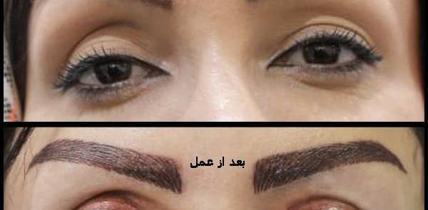 عکس چشم قبل عمل