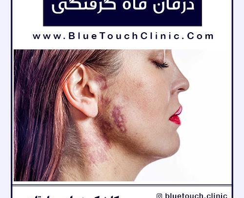 عکس ماه گرفتگی روی صورت