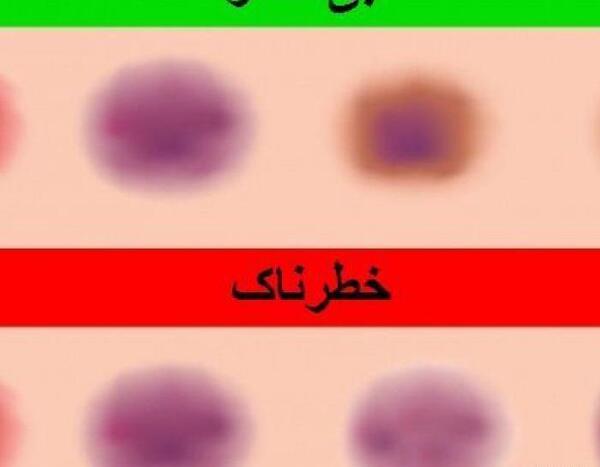 عکس کبودی خطرناک