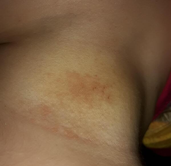 عکس کبودی نی نی سایت