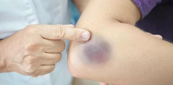 عکس کبودی نی نی سایت