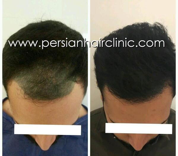 عکس داریوش شجاعیان در کلینیک کاشت مو