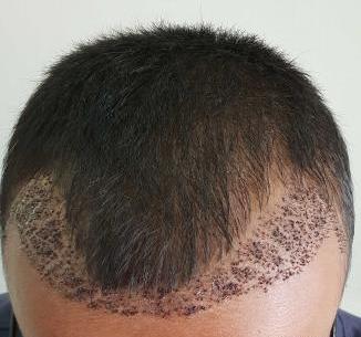 عکس داریوش شجاعیان در کلینیک کاشت مو