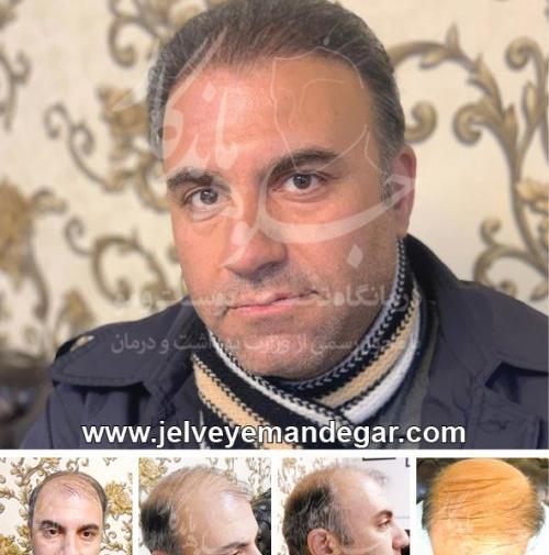 عکس داریوش شجاعیان در کلینیک کاشت مو