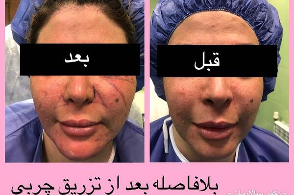 کبودی عکس ورم صورت بعد از تزریق چربی