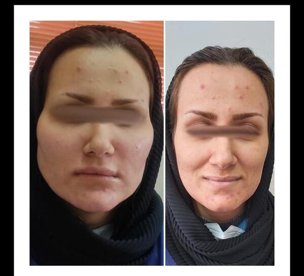 کبودی عکس ورم صورت بعد از تزریق چربی